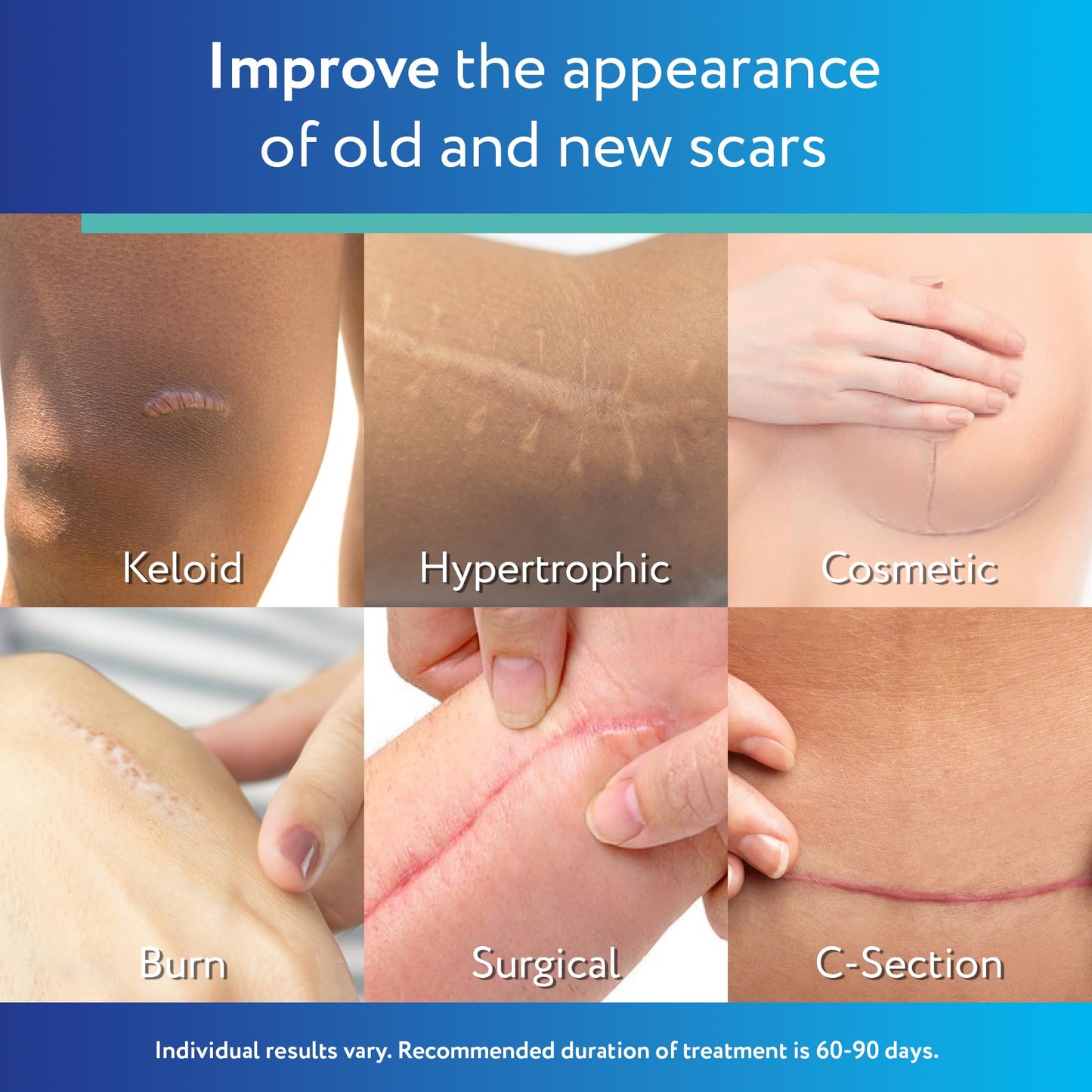 ScarAway Silicone Scar Sheets – Medical Grade Keloid Care – 10 Pack